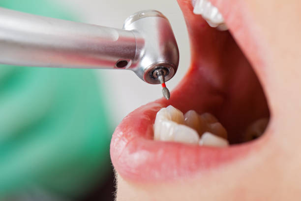 Best Dental Abscess Treatment in Pinckneyvle, IL